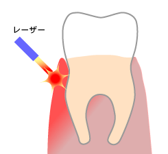 レーザー照射による温熱効果で、歯茎の血行促進