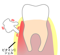 ビタミンＣジェルマッサージで、歯茎の血行とコラーゲン生成を促進